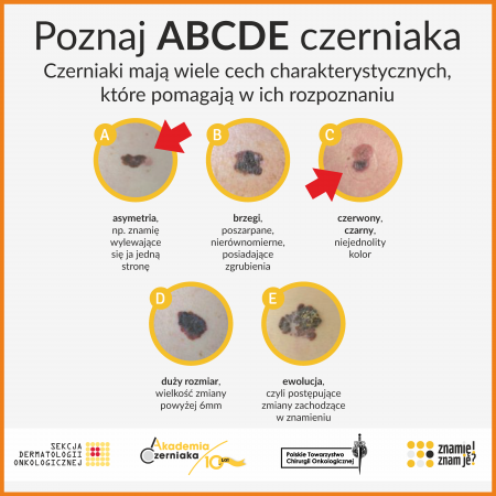 Ulotka informacyjna - Poznaj ABCDE czerniaka